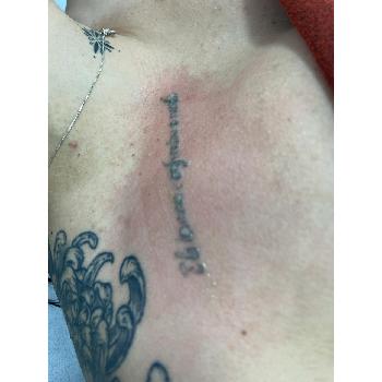 Remoção de Tatuagem Apropriada em Boi Mirim Remoção de Tatuagem Apropriada em Boi Mirim
